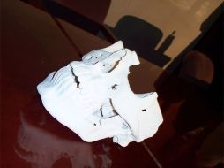 El método empleado por los médicos mexicanos fue utilizar una célula madre dental de su muela del juicio. ID  /