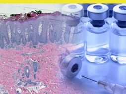 Para el diagnóstico de este padecimiento es necesaria la realización de una biopsia. AGENCIAS ID  /