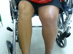 El estudio examinó los casos de más de tres mil afectados por una apoplejía ingresados en 112 hospitales de nueve países. ESPECIAL  /