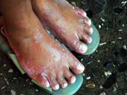 Enfermedades micóticas y otras infecciones han hecho también su aparición en algunas zonas de Tabasco. NOTIMEX  /