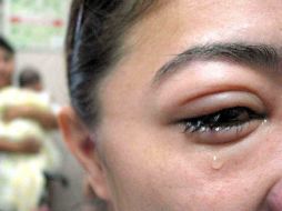 Puerto Vallarta permanece a la cabeza con 36 nuevos casos de conjuntivitis. ARCHIVO  /