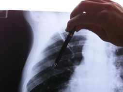 Actualmente el esternón se cierra con alambre de acero y permanece en el pecho tras una toracotomía. EFE  /