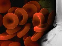 No existe un tratamiento curativo para esta enfermedad. ID  /