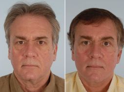 Fotografías del paciente Joe Marek antes (i) y después (d) de someterse a una cirugía estética. EFE  /