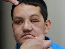 Por primera vez en España, la estructura ósea del tercio medio facial a partir de una prótesis de cerámica. EFE  /