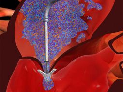 El dispositivo funciona uniendo las valvas de la válvula mitral, una de las cuatro que tiene el corazón. MEDGADGET.COM  /