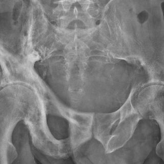 Osteoporosis, aun más riesgosa si existe diabetes