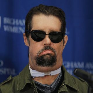 Presentan al hombre que recibió el primer transplante completo de cara