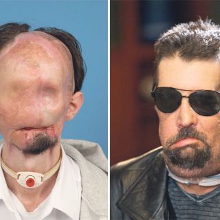 Reaparece en público con trasplante total de cara