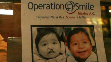 En seis años, la fundación Operation Smile A.C. ha realizado mil cirugías a pacientes de Jalisco y otros estados. ARCHIVO  /