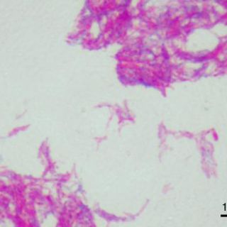 Vacunas contra la tuberculosis son estudiadas al perder su eficacia