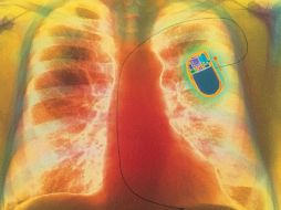 El nuevo nanomarcapasos se puede implantar fácilmente en una cirugía ambulatoria. ESPECIAL  /