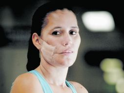 Los especialistas adelantan que Karla deberá someterse a múltiples cirugías reconstructivas. EL UNIVERSAL  /