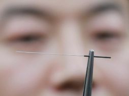 La acupuntura se debe aplicar de manera complementaria con otras terapias. ARCHIVO  /