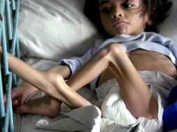 Entre 1,.000 y 15,000 niños menores de cinco años están en riesgo de morir en Guatemala debido a la desnutrición aguda. ARCHIVO  /