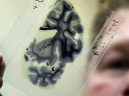 También influyen los antecedentes familiares y generalmente se manifiesta en individuos mayores de 60 años. EFE  /