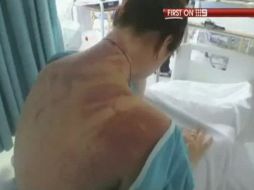 En esta foto, extraida del video, se muestran las huellas de la caída en la espalda de la turista. AP  /