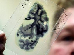 En las imágenes identificaron varias diferencias en los sistemas fronto-estratiales del cerebro que compartían los hermanos. ARCHIVO  /