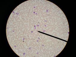 Para el diagnóstico de estas enfermedades, usualmente, se recurre a un análisis de sangre. ID  /