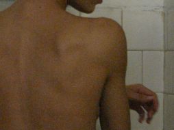 Cáncer de mamas, melanoma, glioma y neuroblastoma humanos pueden ser tratados juntos al ayuno. ARCHIVO  /