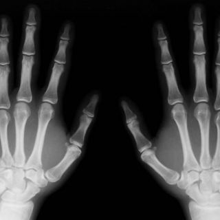 Vitamina E podría perjudicar masa ósea