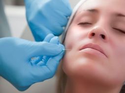 Tambien las intervenciones ''minimamente invasivas'', como el botox y la depilación láser, fueron mas solicitadas. ESPECIAL  /