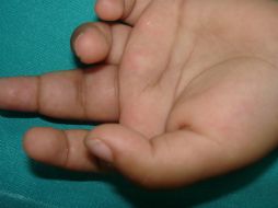 La enfermedad destruye cartílago y erosiona el hueso. ID  /