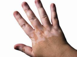 • Para el diagnóstico del vitíligo no es necesario tomar una biopsia. THINKSTOCK  /