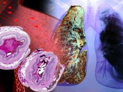 La enfermedad consiste en el mal funcionamiento del epitelio pulmonar. AGENCIA ID  /