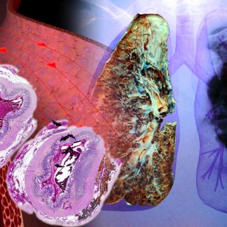 INER busca reducir el índice de muertes por fibrosis pulmonar