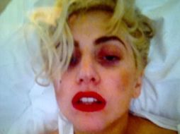 Lady Gaga muestra los estragos del golpe accidental. ESPECIAL  /