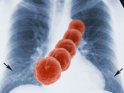 De los 91 serotipos de neumococo, el de mayor frecuencia en la región de Latinoamérica es el 13. AGENCIA ID  /