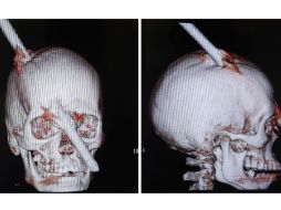 Recreaciones digitales que muestran la dimensión del daño en el cráneo de Eduardo Leite. REUTERS  /