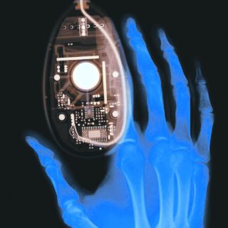 Síndrome del mouse, un mito