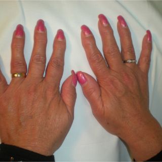 Medicina biológica detiene avance de artritis reumatoide