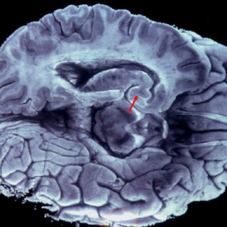 Mutaciones en gen de la inmortalidad generan tumores cerebrales