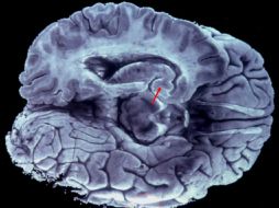 Hasta ahora a los pacientes se les sometía a pruebas mediante instrumental de Tomografía por Emisión de Positrones. EFE /