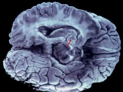 La mayoría de las enfermedades del cerebro son mal comprendidas a día de hoy y no tienen tratamiento. ARCHIVO /