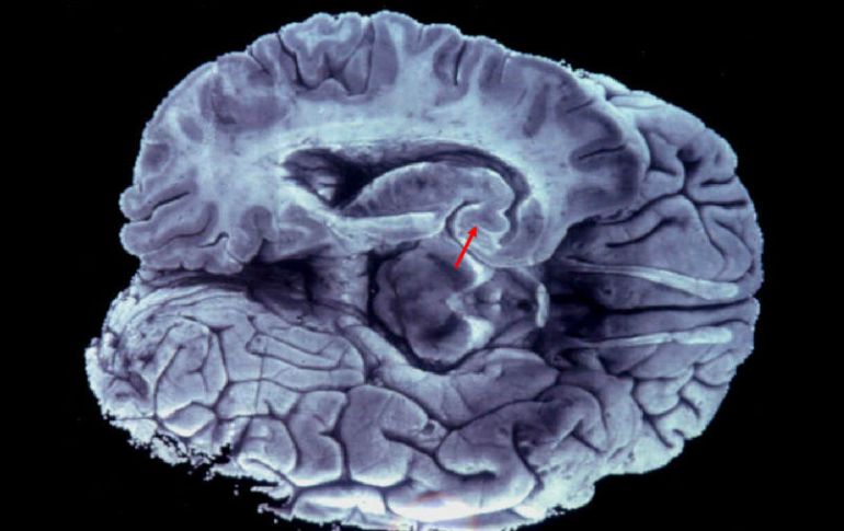 La mayoría de las enfermedades del cerebro son mal comprendidas a día de hoy y no tienen tratamiento. ARCHIVO /