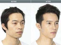 En Corea del Sur, al igual que en otros asiáticos, la operación más popular es cirugía de parpados y operación de mandíbula. ESPECIAL /