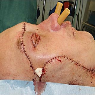 Polaco recibe transplante de rostro