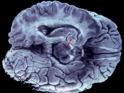 El proyecto le da esperanza a personas que padecen esta enfermedad. ARCHIVO /