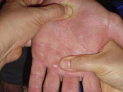 La esclerosis lateral amiotrófica se trata de la pérdida rápida y progresiva de la capacidad de movimiento en músculos. ARCHIVO /