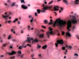 La electroporación es protagonizada por la intervención de hasta seis agujas a manera de electrodos en las células tumorales. ARCHIVO /