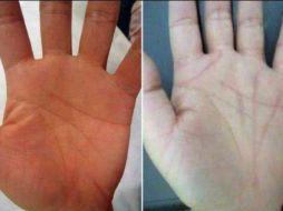 Operación crea nuevas líneas en la mano.  Foto. Shonan Beauty Clinic. ESPECIAL /