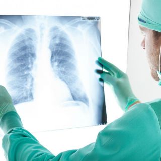 Prueban eficacia de nuevas terapias contra cáncer de pulmón