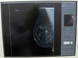 El IMSS cuenta con acciones específicas para la prevención, la detección y el control del cáncer de mama. ARCHIVO /