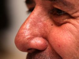 El problema de desviación de tabique es más propenso en personas de entre 20 y 40 años de edad. ARCHIVO /