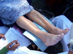 Los músculos de los pies se debilitan, de ahí que los dedos se deformen (dedos en garra) y los pies tiendan también a modificarse. ARCHIVO /