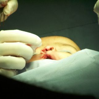 Las células madre pueden corregir el labio leporino